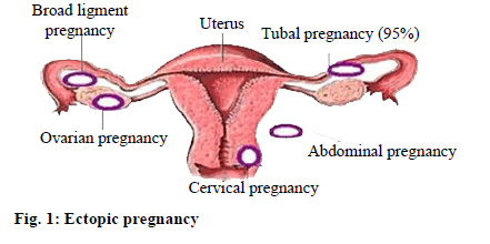 Ectopic