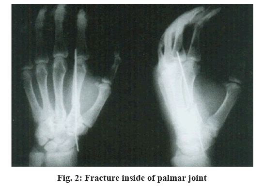 Fracture