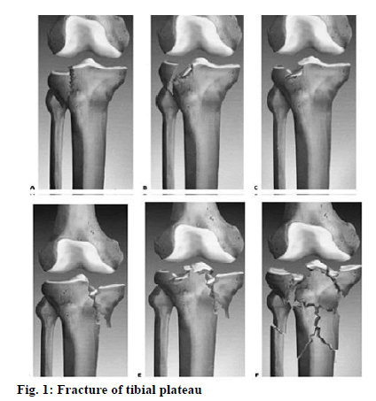 Fracture