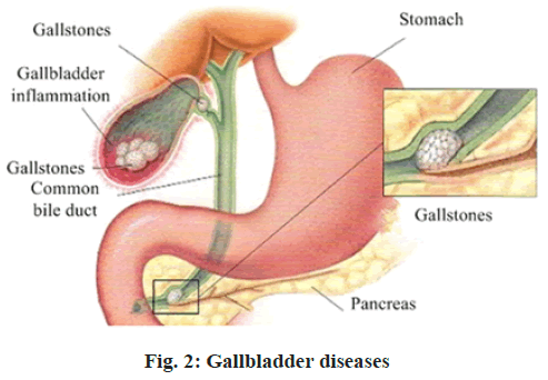 IJPS-Gallbladder