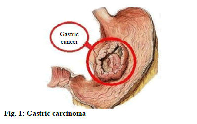 Gastric