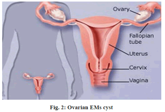 Ovarian