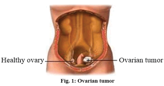 Ovarian