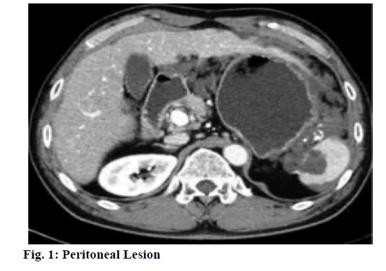 IJPS-Peritoneal