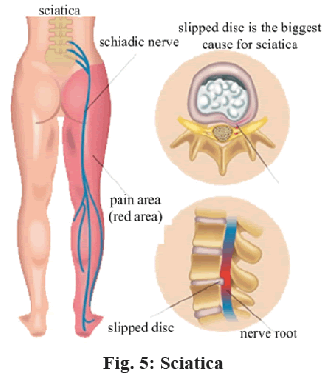 Sciatica