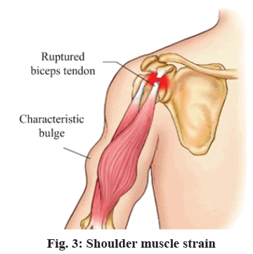 IJPS-Shoulder