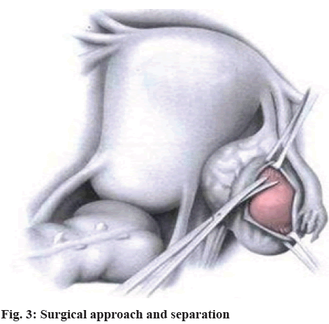 IJPS-approach