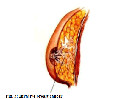 IJPS-breast