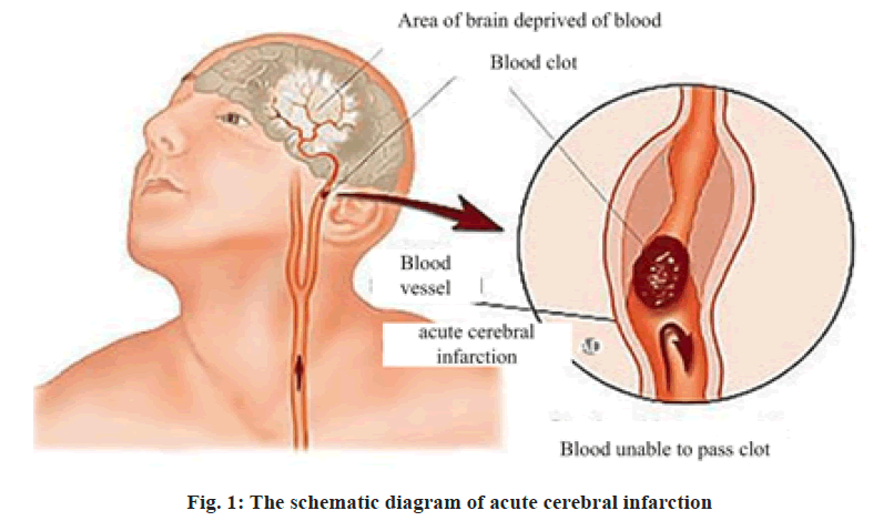 cerebral