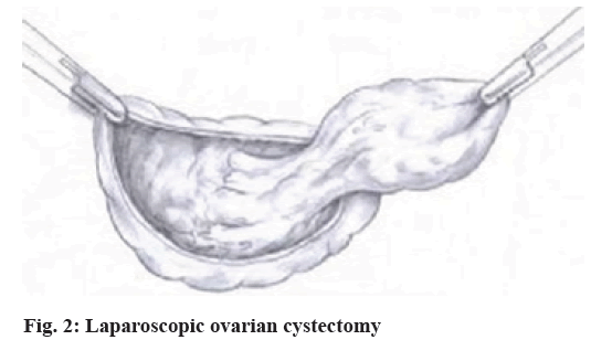 IJPS-cystectomy