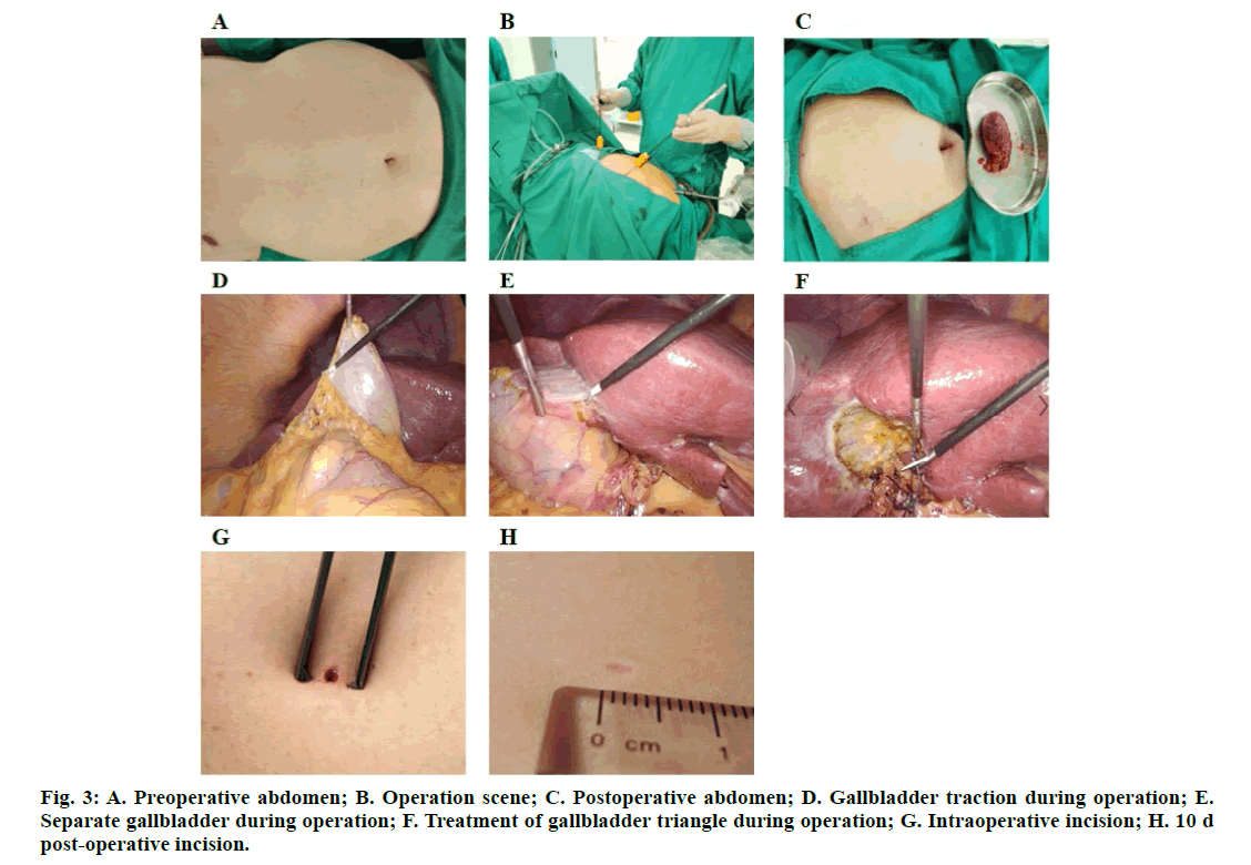 IJPS-gallbladder