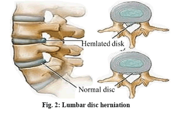 herniation