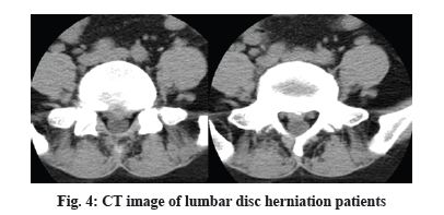 herniation