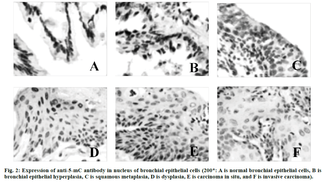 hyperplasia