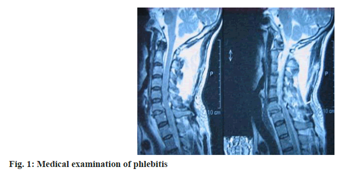 IJPS-phlebitis