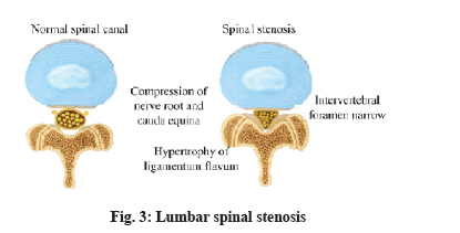 spinal