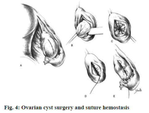 IJPS-suture