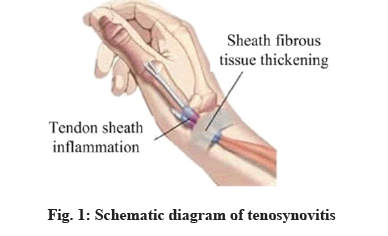 IJPS-tenosynovitis