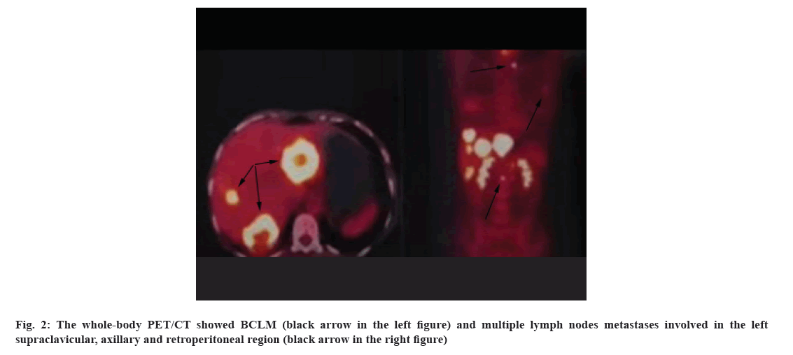 IJPS-lymph