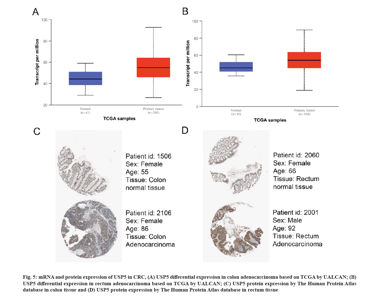 IJPS-adenocarcinoma