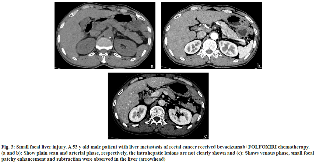 bevacizumab