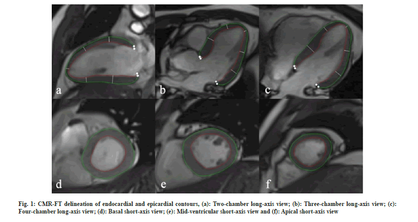 IJPS-endocardial