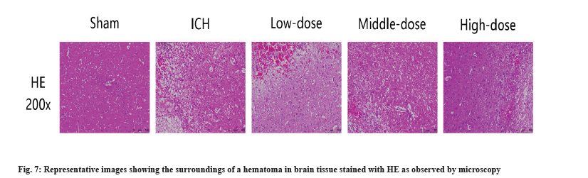 hematoma