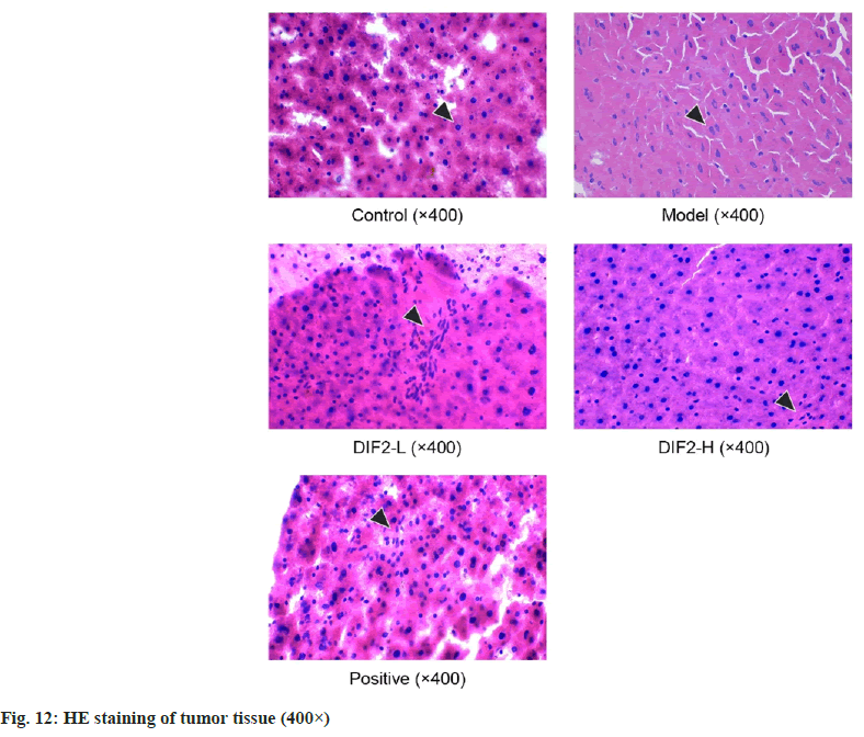 IJPS-tumor