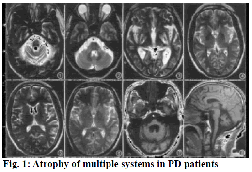 IJPS-Atrophy