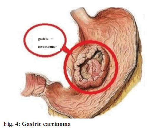 IJPS-Gastric