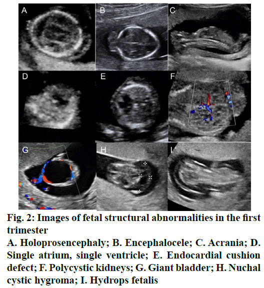 IJPS-Holoprosencephaly