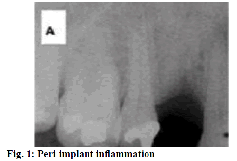 IJPS-Peri-implant