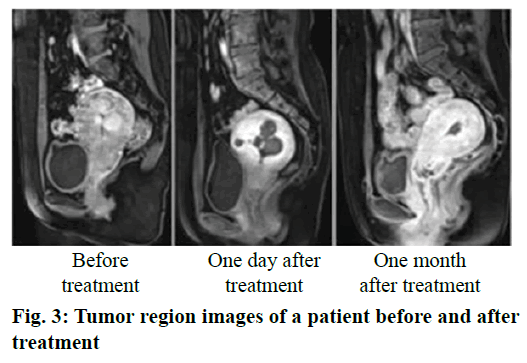 IJPS-Tumor-region