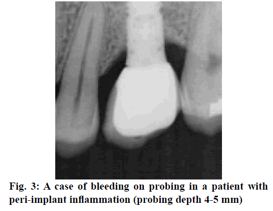 IJPS-bleeding