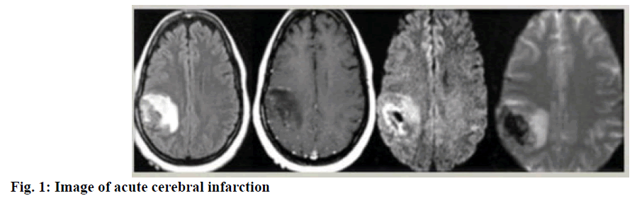 IJPS-cerebral-infarction