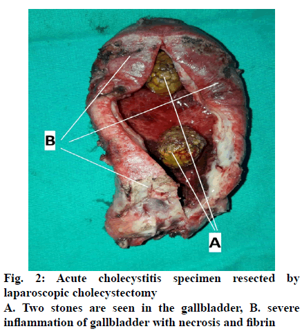 IJPS-cholecystitis-specimen