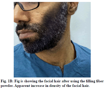 Review of Topical Therapies for Beard Enhancement