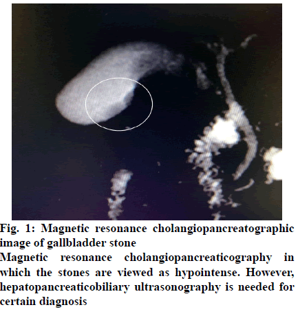 IJPS-gallbladder-stone