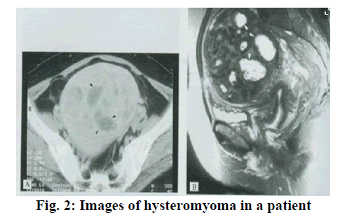 IJPS-hysteromyoma