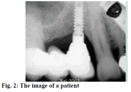 IJPS-patient