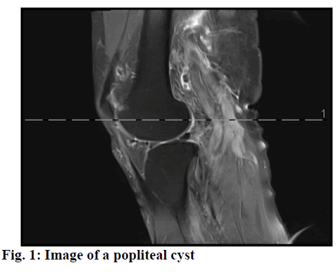 IJPS-popliteal-cyst