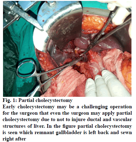 IJPS-remnant-gallbladder