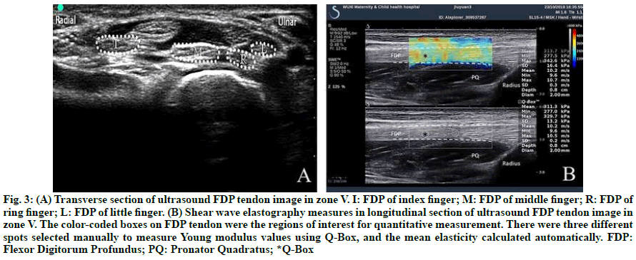 IJPS-tendon-image