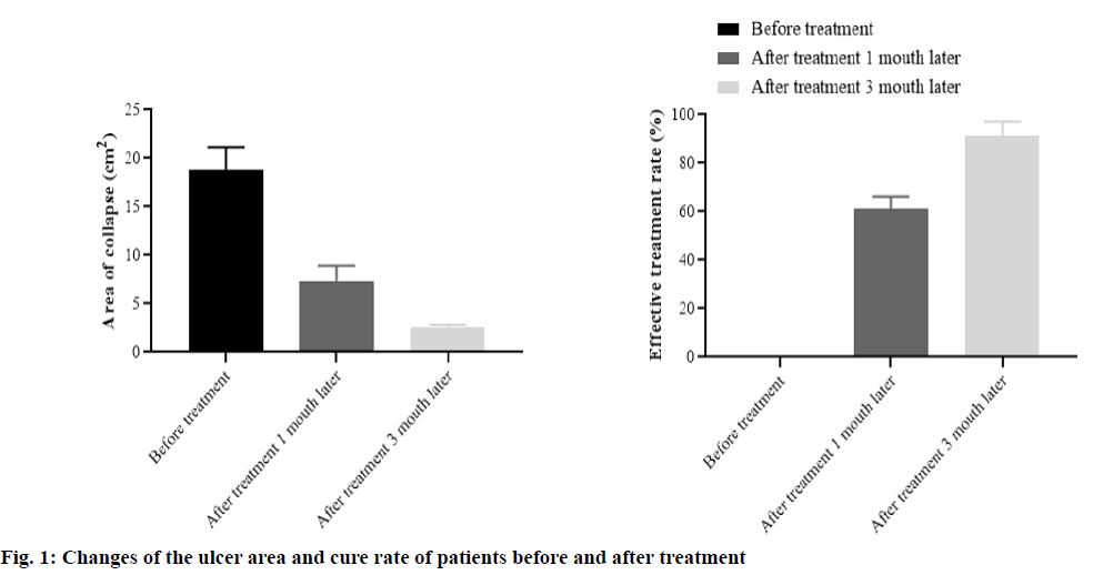 IJPS-ulcer