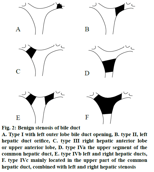 ijps-bile-duct