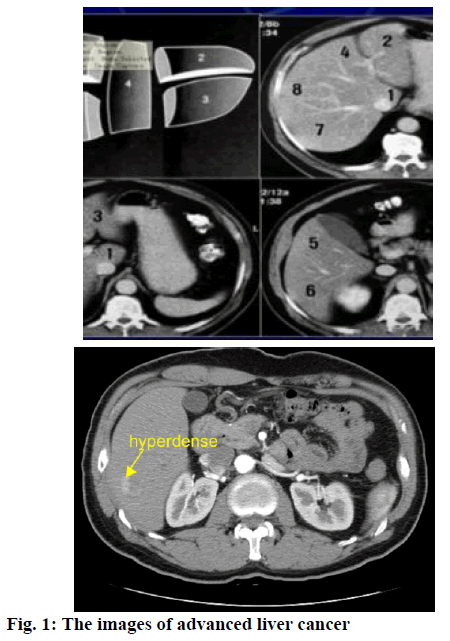 ijps-liver-cancer