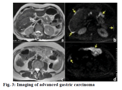 ijpsonline-advanced-gastric-carcinoma