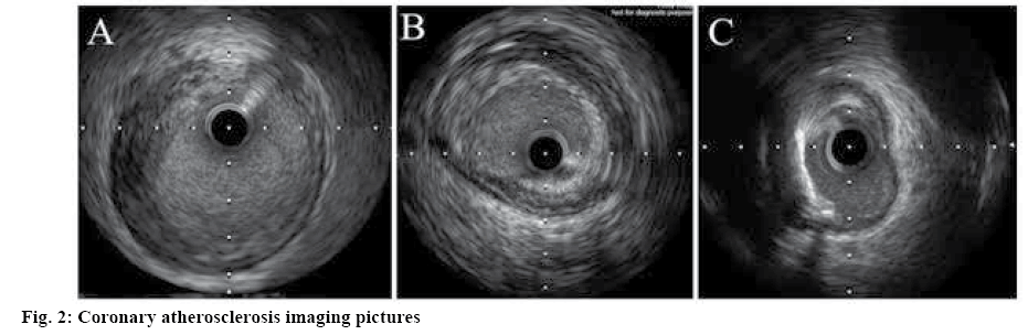 ijpsonline-atherosclerosis