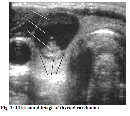 ijpsonline-carcinoma