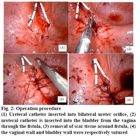 ijpsonline-catheter